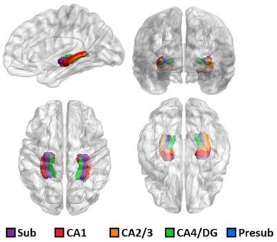 Stress-related reduction of hippocampal subfield volumes in major depressive disorder: A 7-Tesla study